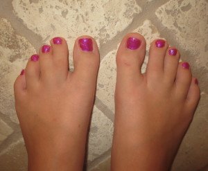 syndactyly