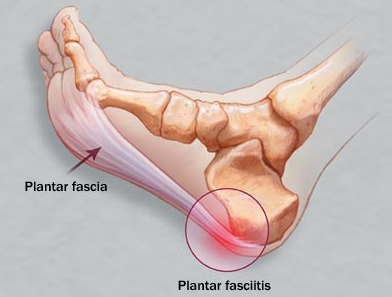 Plantar_fasciitis